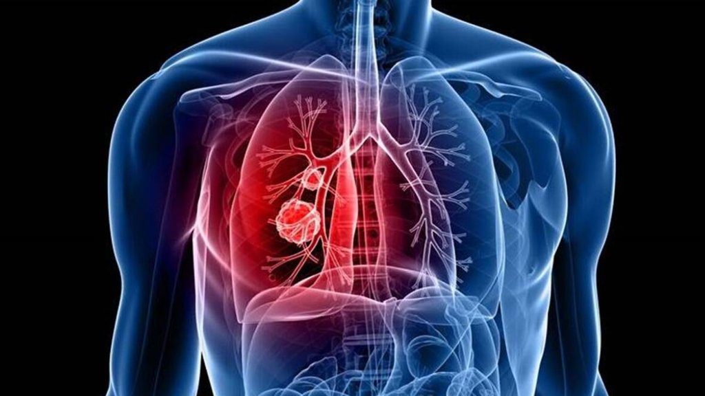 cancer threat | breast cancer| lung cancer|