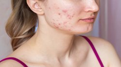 Acne Scars: चेहरे पर मुहांसों से हैं परेशान तो खानपान में इन चीजों से बना लें दूरी