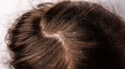 Dandruff Treatment: डैंड्रफ-खुजली से हैं परेशान हैं तो अपनाएं ये आयुर्वेदिक हेयर मास्क, बस 3 हफ्ते में मिलेगा छुटकारा