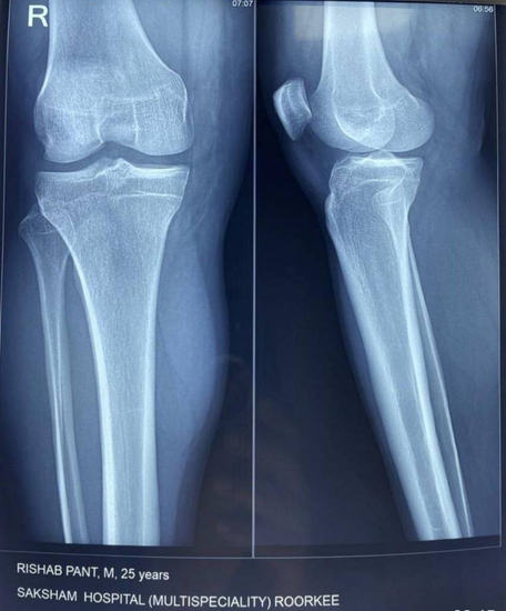 Rishabh Pant X-ray Report
