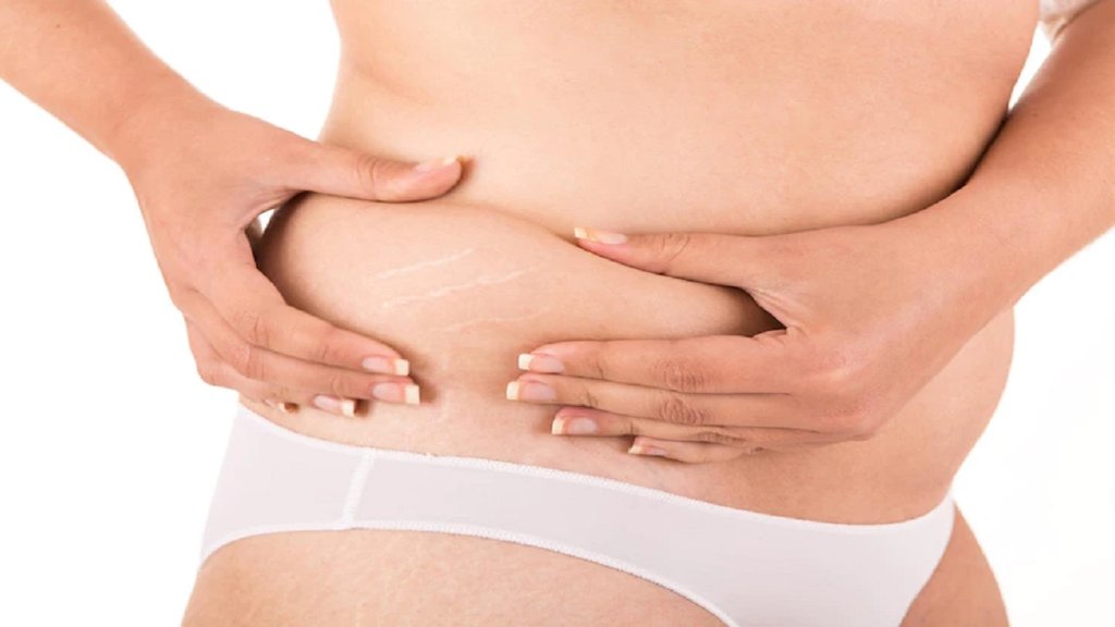 Remedies for stretch mark, remedies to remove stretch marks,