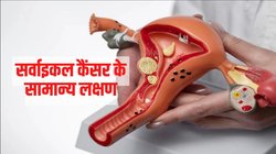 Cervical Cancer: भारतीय महिलाओं में सबसे आम है यह कैंसर, एक्सपर्ट से जानिए लक्षण और बचाव के तरीके
