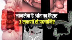 Colon Cancer: पेट से हड्डियों तक फैल सकता है कोलन कैंसर, इन 3 लक्षणों से पहचानें जानलेवा कर्क रोग