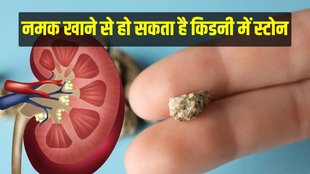 kidney stone symptoms, kidney stone cause, what foods cause kidney stones