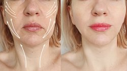 Wrinkle Free Skin: यंग एज में चेहरे पर झुर्रियों से हैं परेशान? इन घरेलू उपायों से पा सकते हैं छुटकारा