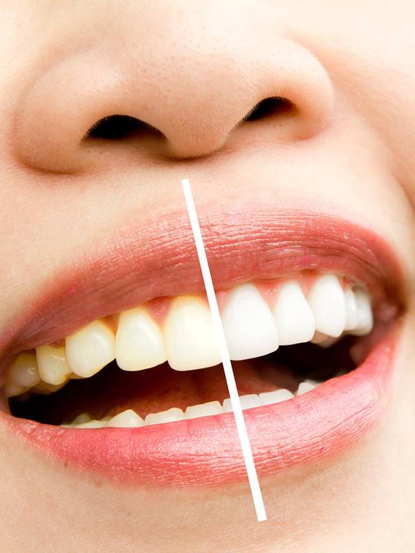 woman teeth before and after whitening. Over white background