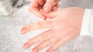 brittle nails, white spots on nail,