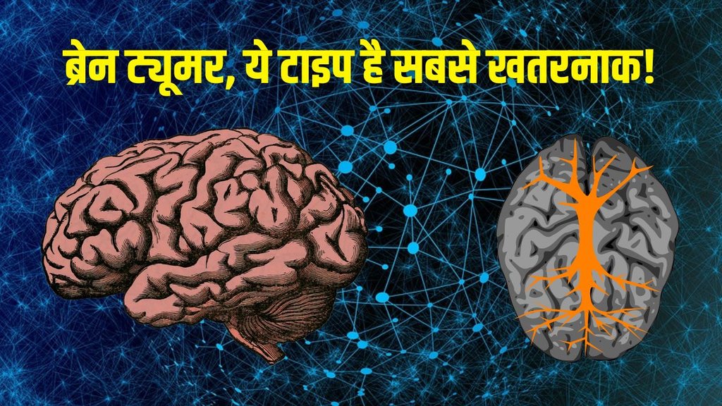 Brain Cancer | Brain Tumour | Brain Tumour Symptoms