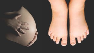 hand swelling in pregnancy, Swelling in pregnancy, Swollen feet and hands in pregnancy