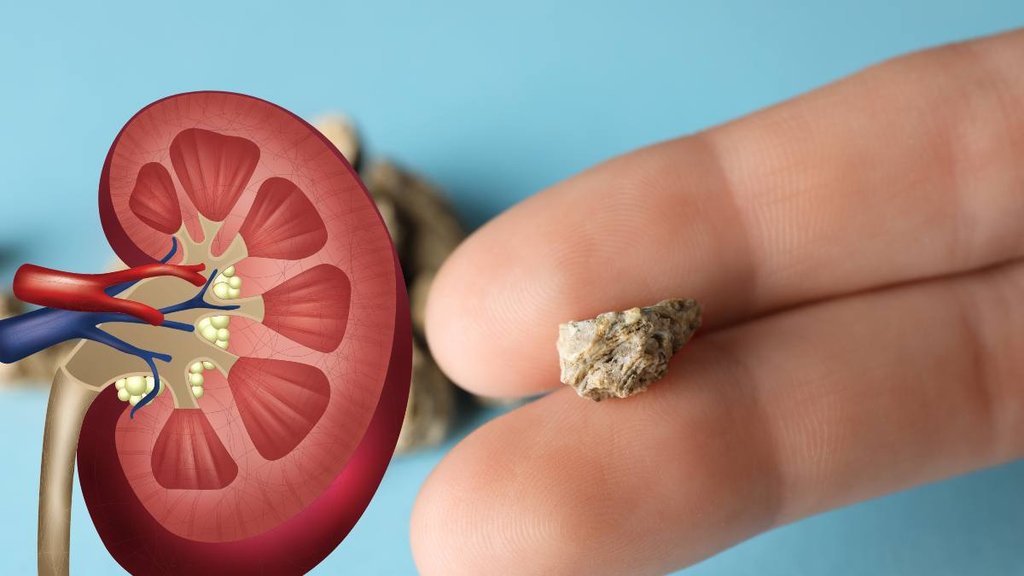 kidney stone symptoms, kidney stone cause, what foods cause kidney stones