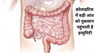 ulcerative colitis in hindi,ulcerative colitis symptoms and sign,ulcerative colitis cure