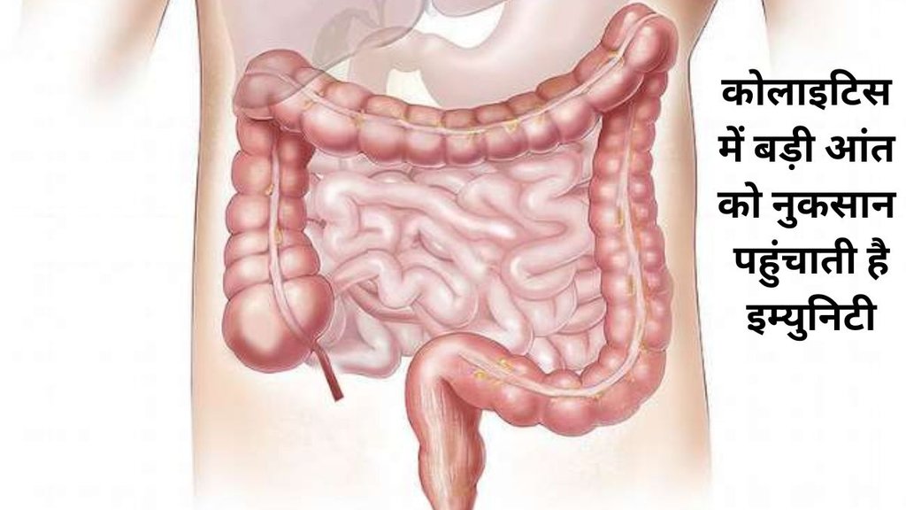 ulcerative colitis in hindi,ulcerative colitis symptoms and sign,ulcerative colitis cure