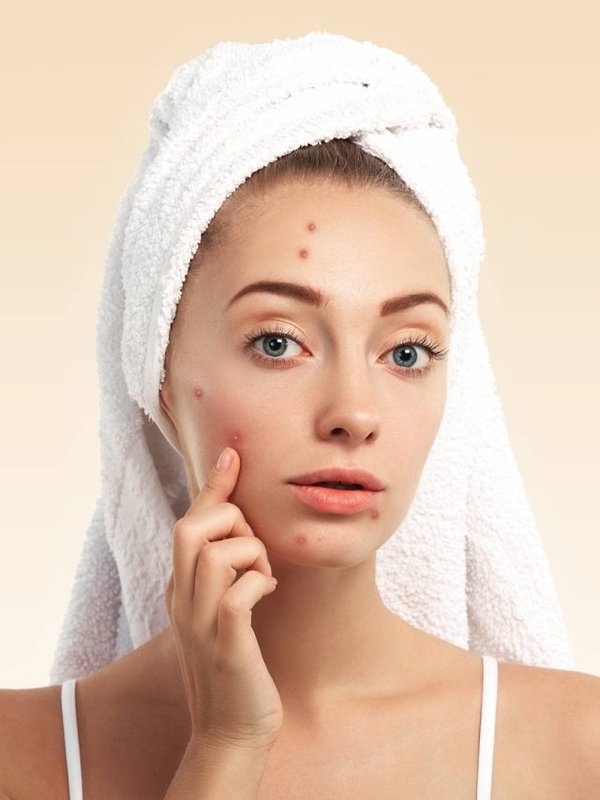 Close up isolated portrait of beautiful young Caucasian woman with blue eyes and problem skin, looking at the camera, pointing at pimple wearing white towel on her head against blue studio background