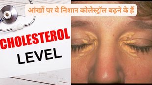 High Cholesterol, How High Cholesterol Affects Your Eyes, High Cholesterol and eyes, High Cholesterol signs in your skin, Early Signs In Your Eyes That You Should Not Ignore,
