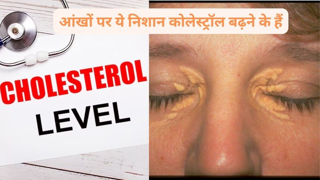 High Cholesterol, How High Cholesterol Affects Your Eyes, High Cholesterol and eyes, High Cholesterol signs in your skin, Early Signs In Your Eyes That You Should Not Ignore,