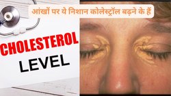 कोलेस्ट्रॉल का पारा 160 से 189 mg/dL तक पहुंचने पर आंखें समेत स्किन पर दिखते हैं ये 4 वॉर्निंग साइन, आसान है पहचानने का तरीका