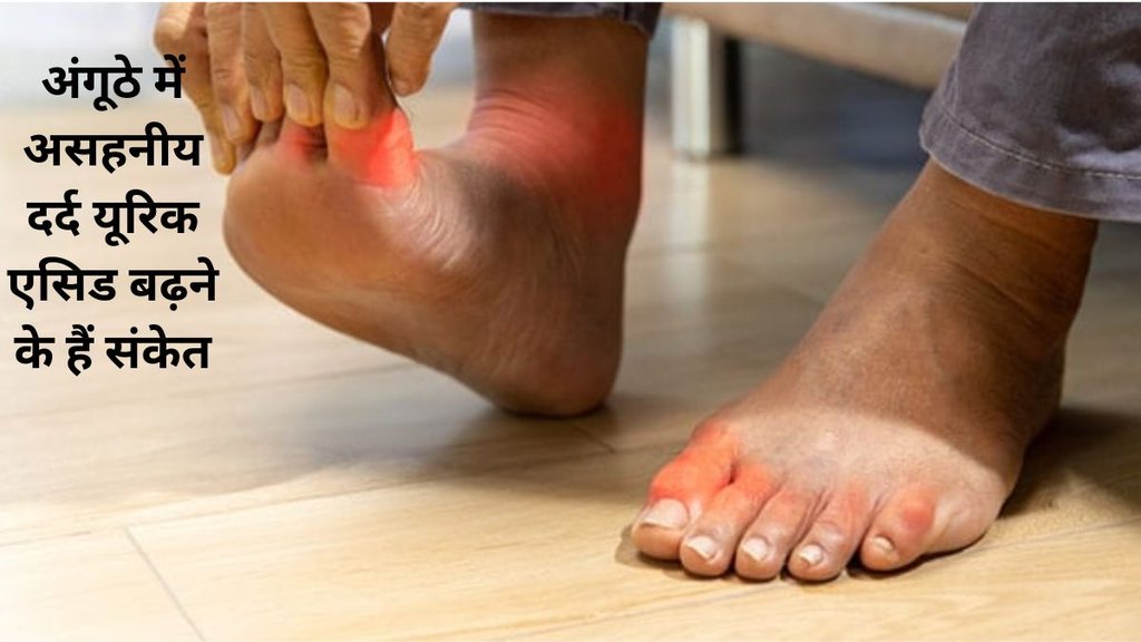 Minter Water,Uric Acid,Minter Water For Uric Acid,How to Reduce Uric Acid,
