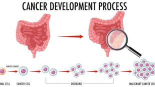 healthy lifestyle, cancer drug, cancer clinical trial, cancer treatment, cure for cancer, rectal cancer,rectal cancer symptoms,