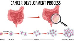Early Sign of Rectal Cancer: पॉटी में दिखें ये 4 बदलाव तो हो सकते हैं रेक्टल कैंसर के संकेत, अलर्ट होकर करें लक्षणों की पहचान, इलाज में होगी आसानी