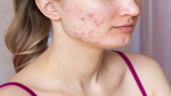 Acne Cure: चेहरे के मुहांसों की संख्या दिन-ब-दिन बढ़ती जा रही है, तो फेस वॉश करने के बाद इन 3 खास तेल से करें मसाज, चेहरा दिखेगा क्लीन