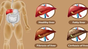 world liver day 2023, fatty liver, fatty liver signs, fatty liver symptoms,