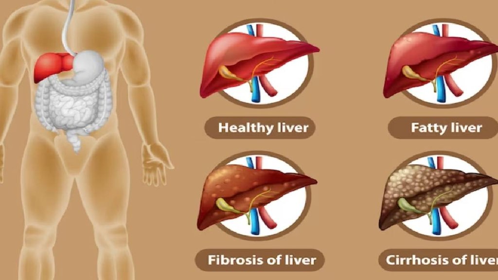 world liver day 2023, fatty liver, fatty liver signs, fatty liver symptoms,