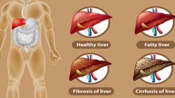 World Liver Day 2023: शराब को हाथ लगाएं बगैर हर चौथा युवा हो रहा फैटी लिवर का शिकार, जानिए कारण और लक्षण