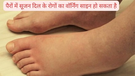 सूजन के लक्षण और संकेत (Signs and Symptoms of Swelling)