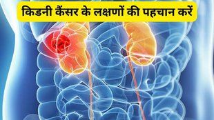 how to get prevent of kidney cancer,Kidney Cancer,Kidney Cancer Signs,Kidney Cancer Symptoms,Kidney Cancer Treatment,