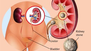 watermelon juice for kidney stone, benefits of watermelon juice, uric acid watermelon juice, benefits of watermelon