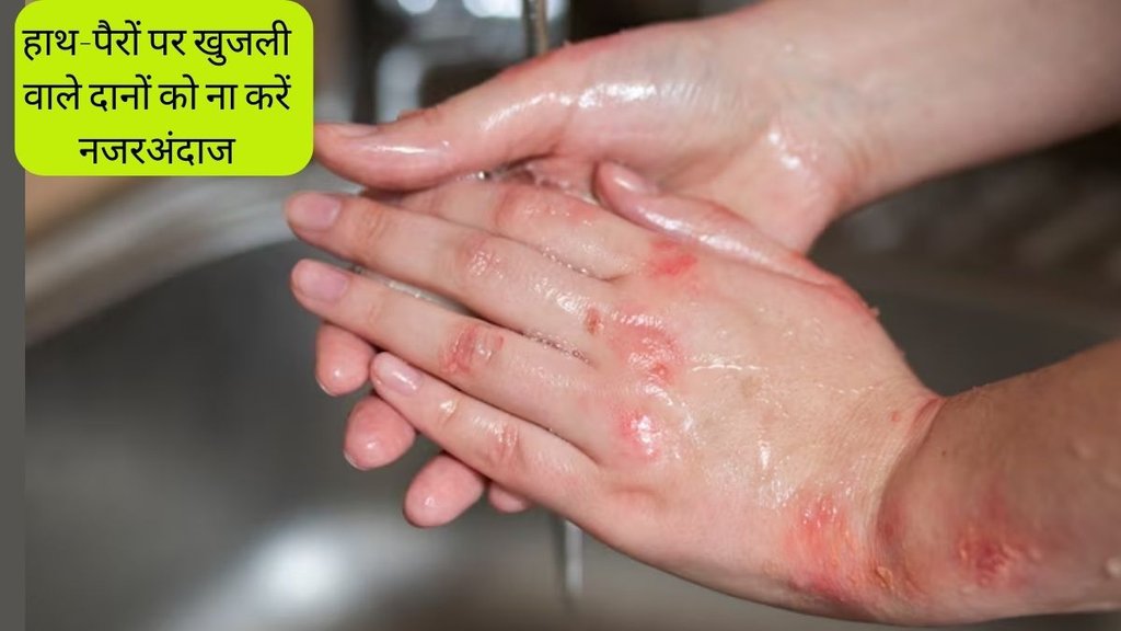 HSV, Pimple on Hands, Watery Pimple on Hands, Herpes Causes