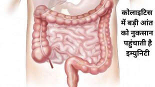 what is the main cause of ulcerative colitis, what is life expectancy with ulcerative colitis, what happens when you have ulcerative colitis, what are the warning signs of ulcerative colitis