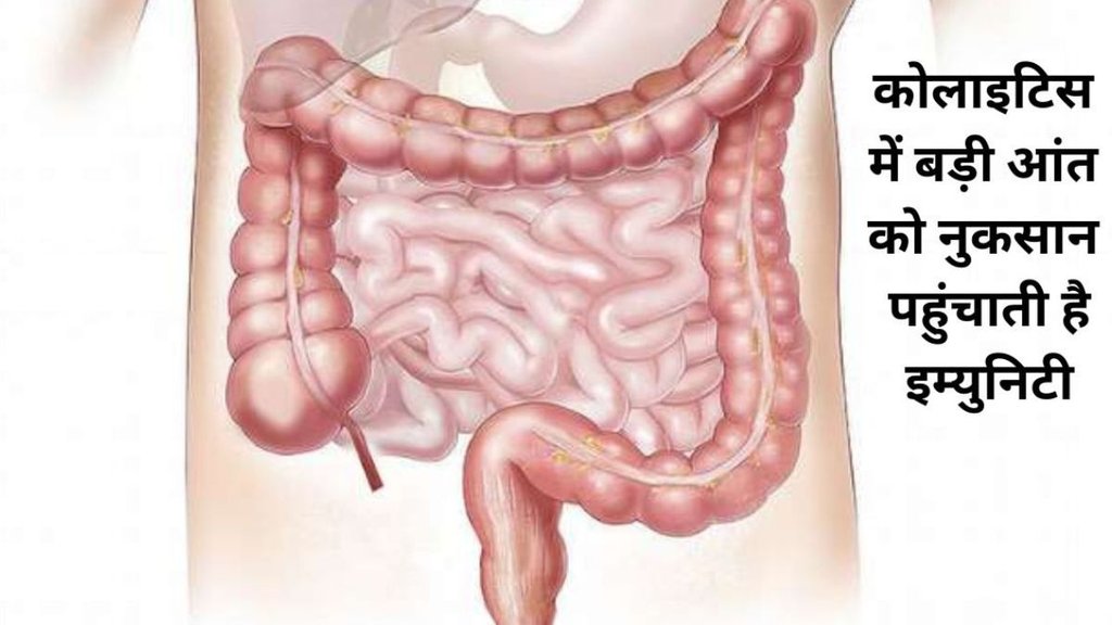 what is the main cause of ulcerative colitis, what is life expectancy with ulcerative colitis, what happens when you have ulcerative colitis, what are the warning signs of ulcerative colitis what is the main cause of ulcerative colitis, what is life expectancy with ulcerative colitis, what happens when you have ulcerative colitis, what are the warning signs of ulcerative colitis