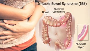 IBS,lifestyle,health,irritable bowel syndrome, irritable bowel syndrome treatment, irritable bowel syndrome in hindi, irritable bowel syndrome diet, irritable bowel syndrome home remedies