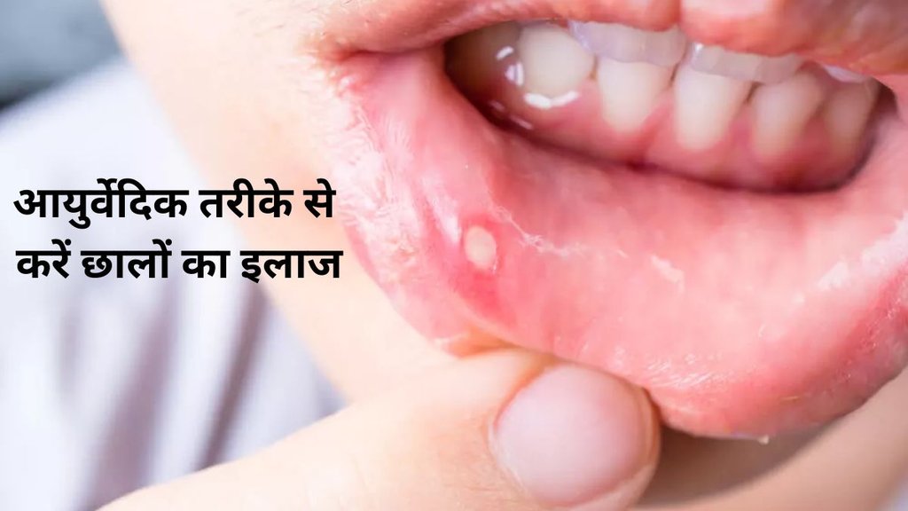 mouth ulcer,home remedies for the treatment of mouth ulcers,Ayurvedic expert Acharya Balakrishna, Ayurvedic Treatment for Mouth Ulcers