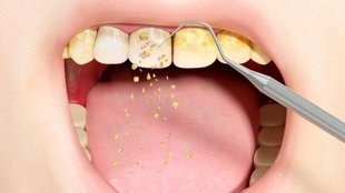 Teeth Whitening Tips । home remedies for white teeth । How to Get Rid of Yellow plaque on Teeth । How to Get Rid of Yellow Teeth