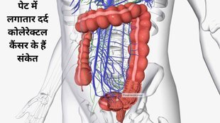 What is colorectal cancer, symptoms of colorectal cancer, Causes of colorectal cancer, treatment of colorectal cancer, what is colorectal cancer