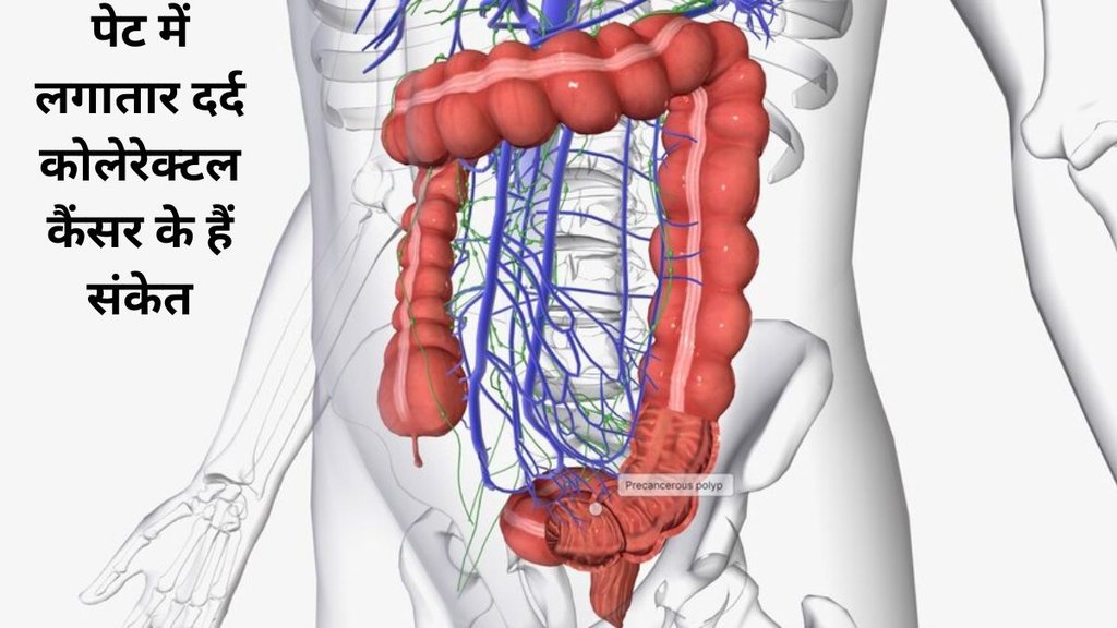 What is colorectal cancer, symptoms of colorectal cancer, Causes of colorectal cancer, treatment of colorectal cancer, what is colorectal cancer