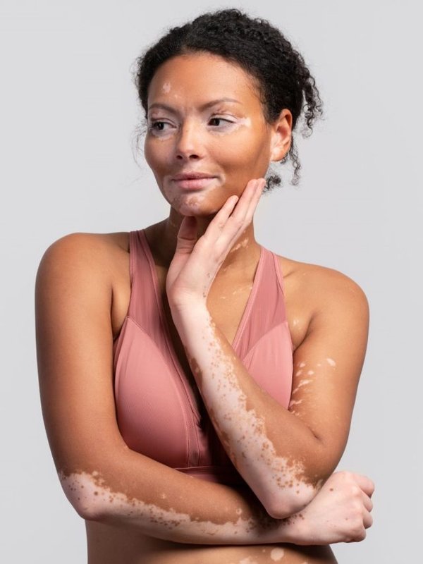 World Vitiligo Day (4)