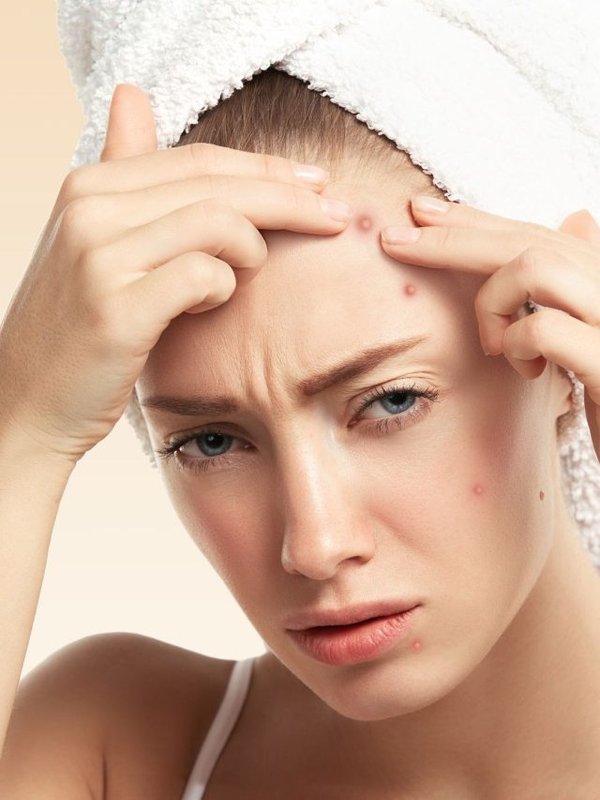 avoid pimples in monsoon (3)