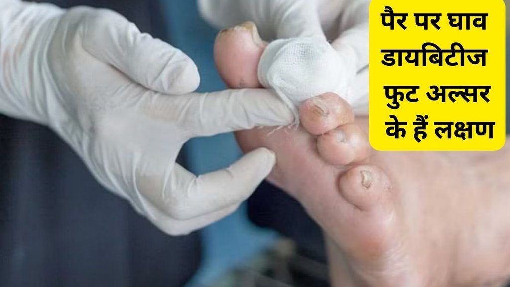 Diabetic foot ulcer cure,Diabetic foot ulcer treatment
