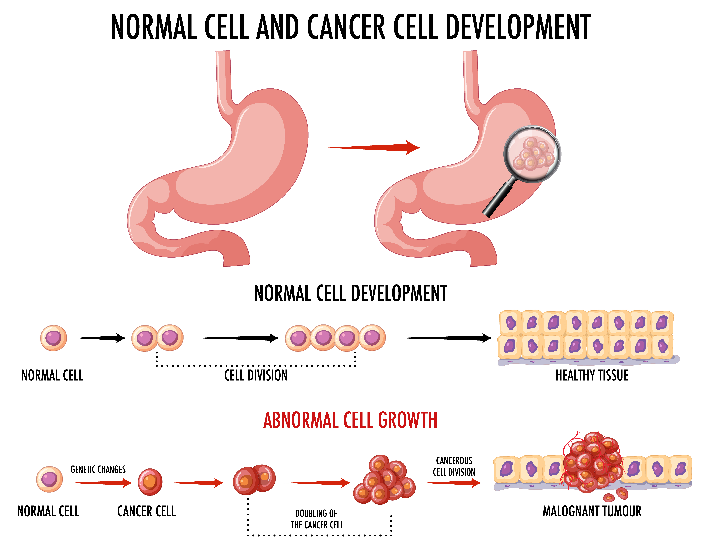 Cancer, Cancer cells, stomach cancer
