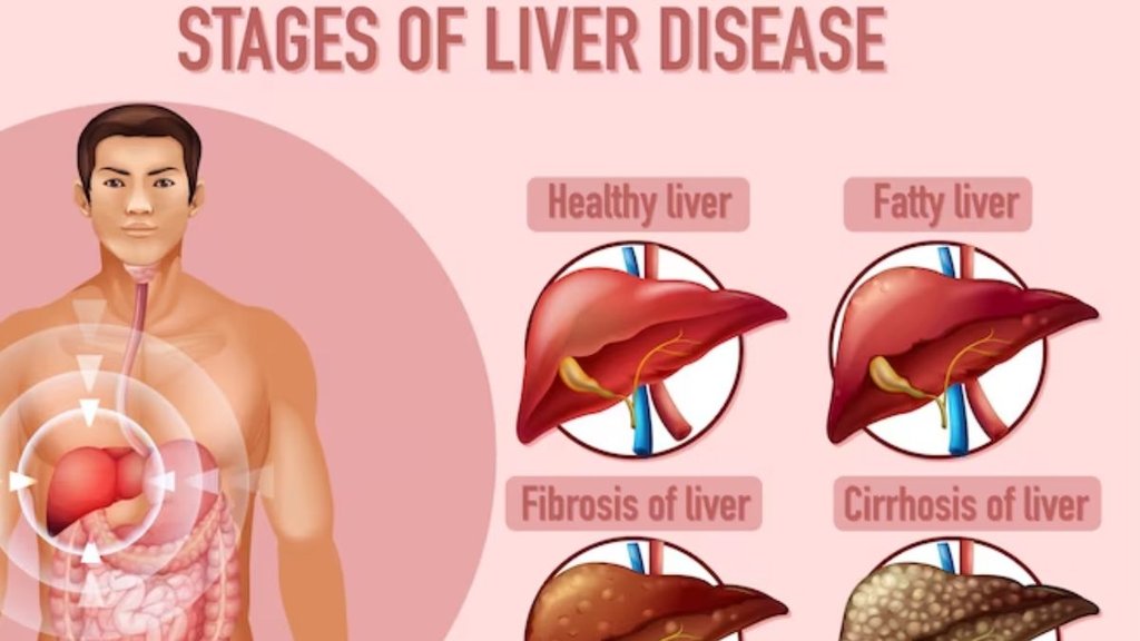लीवर को सेहतमंद कैसे रखे, लीवर खराब होने के लक्षण, FATTY LIVER