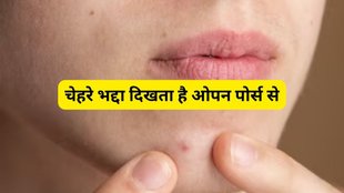 lifestyle,Skin care tips remedy,open pores,best nuskha for open pores,open pores ayurvedic remedies,open pores home remedies,open pores kaise hatayein,open pores ke gharelu upay,best upay for open pores
