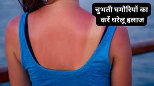prickly heat, Home Remedies, summer Home Remedies, Home Remedies For Ghamori, Heat Rash in Hindi, Ghamori ke karan, Ghamori ke gharelu ilaj