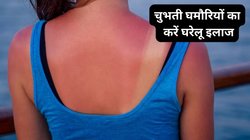 Prickly Heat: उमस भरी गर्मी में गर्दन पर चुभन वाले दाने और घमौरियां कर रही हैं परेशान, इन 5 टिप्स से चुटकियों में दूर होगी समस्या