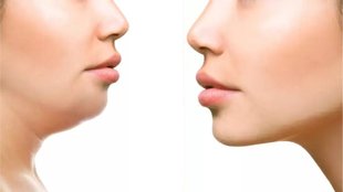double chin । how to reduce double chin । how to reduce double chin Fat । how to get rid of double chin