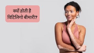 World Vitiligo Day । World Vitiligo Day 2023 । what is vitiligo । vitiligo Symptoms in hindi