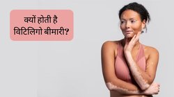 World Vitiligo Day 2023: क्या है विटिलिगो? त्वचा पर सफेद धब्बों से पहले दिखाई देते हैं ये लक्षण, जानें कैसे करें पहचान