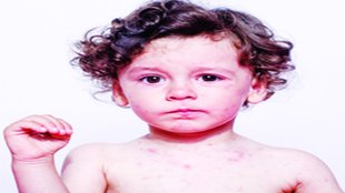 Baby health care | heat rash | protect in summer and rainy days |